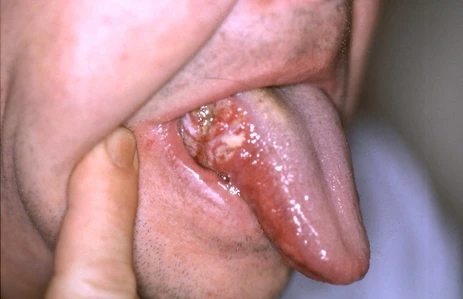 Oral tongue cancer lesion treated by Dr Smit A. Desai, head and neck cancer surgeon in Ahmedabad.
