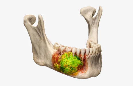 Medical illustration of ameloblastoma and aggressive benign jaw lesions affecting the lower jaw, shown as a locally aggressive jaw tumour. Such cases may require craniofacial surgery, craniofacial reconstruction surgery, skull base surgery ENT, or ENT skull base surgery. Relevant for patients searching for craniofacial surgery in India and craniofacial surgery cost.
