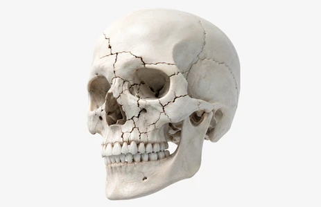 Medical illustration showing complex craniofacial trauma with midface, orbital, and panfacial fractures. Severe facial injuries may require craniofacial surgery, craniofacial reconstruction surgery, and skull base surgery ENT, relevant to craniofacial surgery in India and treatment planning.
