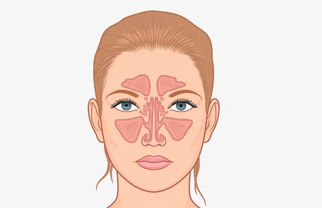 Medical illustration showing the maxillary and sinonasal sinus areas of the face affected by sinus and sinonasal cancer.