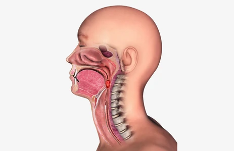 Medical illustration of oral cancer spreading to the skull base, showing advanced mouth or tongue cancer extending backward through deeper tissues and nerves. This condition may require craniofacial surgery, craniofacial reconstruction surgery, skull base surgery ENT, and ENT skull base surgery. Relevant for patients searching for craniofacial surgery in India and craniofacial surgery cost.