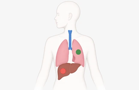 Medical illustration showing recurrent tumours in operated or irradiated fields, representing cases considered for salvage treatment. These complex cases may require craniofacial surgery, craniofacial reconstruction surgery, skull base surgery ENT, or ENT skull base surgery. Relevant for patients searching for craniofacial surgery in India and craniofacial surgery cost.