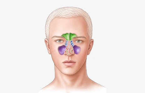Medical illustration of sinonasal squamous cell carcinoma showing the nasal and sinus region, related to craniofacial surgery in India, craniofacial reconstruction surgery, skull base surgery ENT, and ENT skull base surgery.