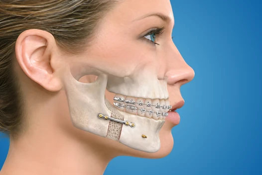 Illustration of jaw reconstruction with implants for maxillofacial prosthesis and oral cancer rehabilitation after surgery