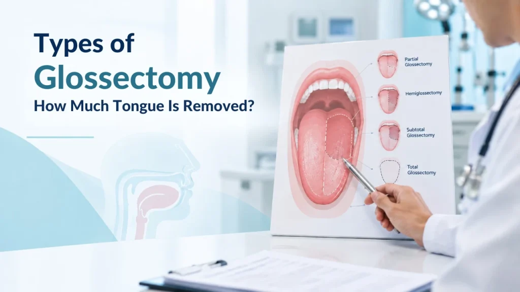 Types of glossectomy diagram showing partial, hemi, subtotal and total glossectomy and how much tongue is removed
