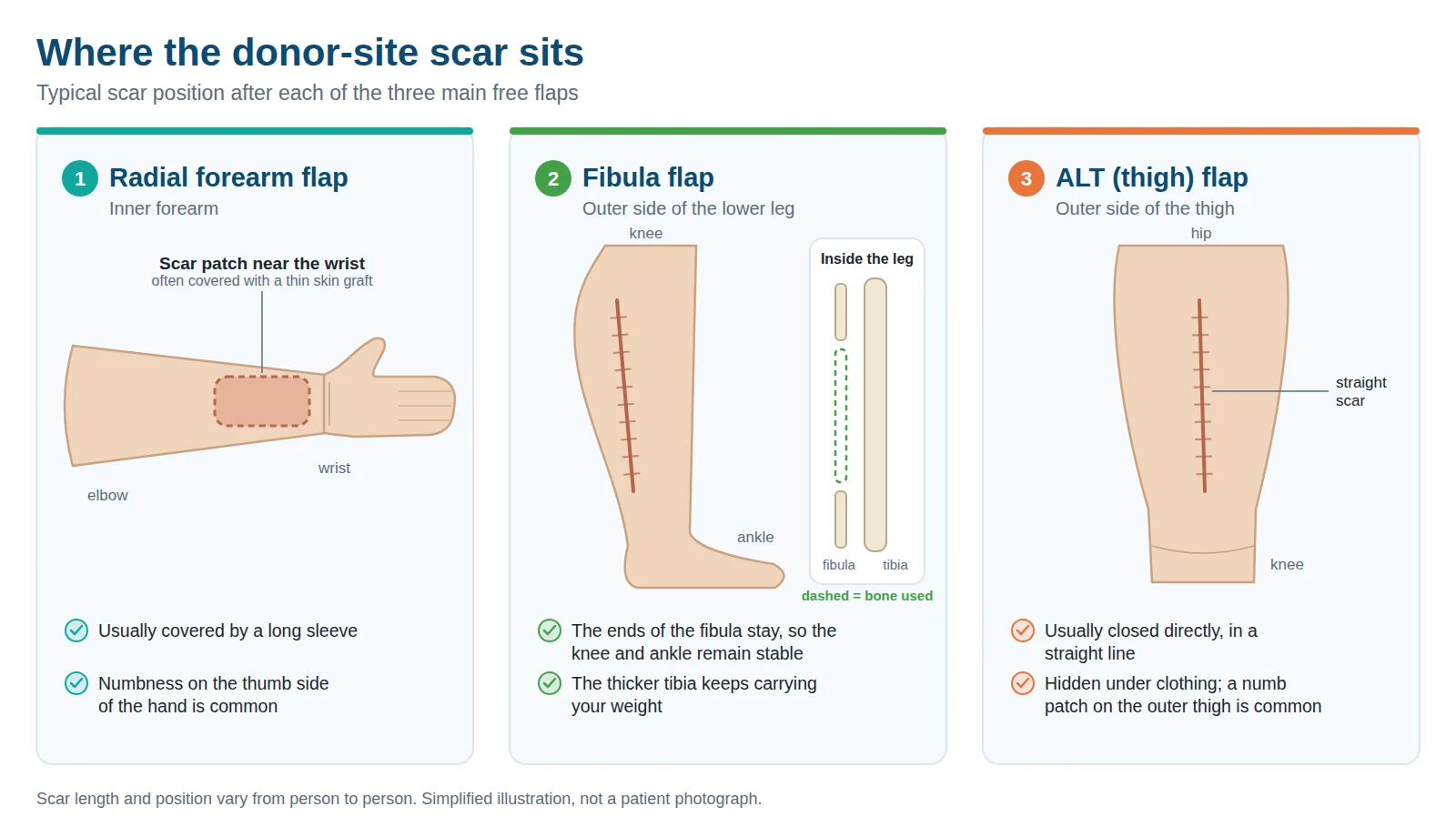 Diagram showing where the donor-site scar sits after a forearm, fibula or thigh free flap.