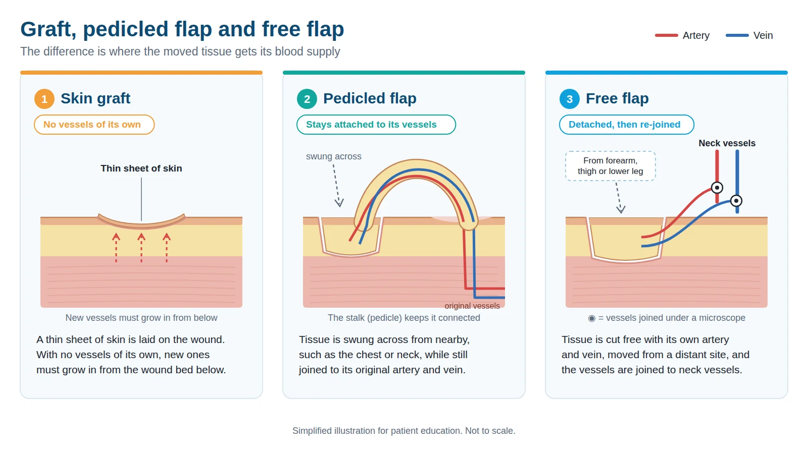 Diagram comparing a skin graft, a pedicled flap and a free flap by their blood supply.